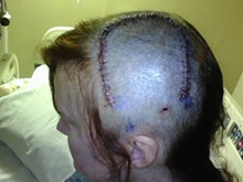 Susan's Story (Brain Tumor)