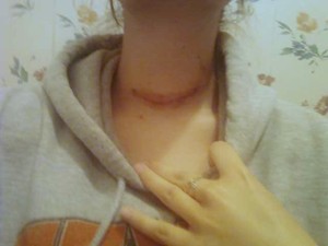 Catie's Story (Tumors)