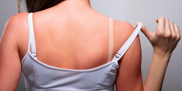 sunburn