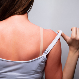 sunburn 