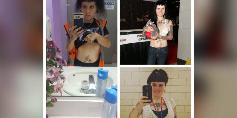 racheals-story-osteogenesis-imperfecta