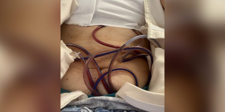 Yvonne's Story Breast Cancer
