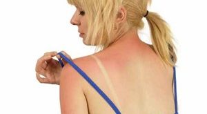 How To Treat Sunburns