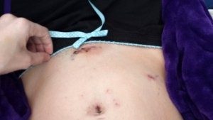 Jolene's Story Endometriosis